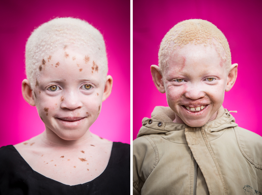 Headshots showcasing the unique and radiant features of albino children.